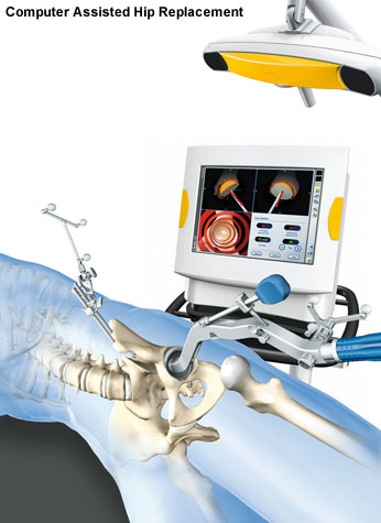 Computer Assisted Hip Replacement