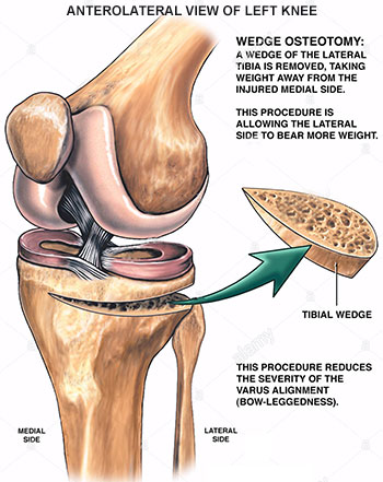 Knee Osteotomy Procedure