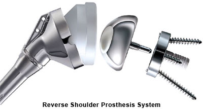Revese Shoulder Prosthesis System